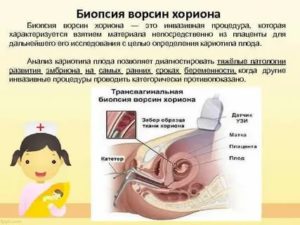 Замершая беременность, нарушение развития ворсин хориона
