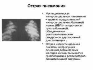 Консультация по неспецифическая интерстициальная пневмония