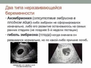 Неразвивающаяся маточная беременность по типу анэмбрионии