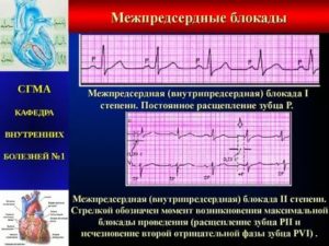 Блокада пучка Бахмана