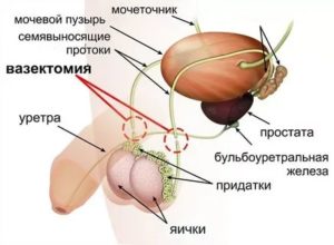Вазэктомия и вазорезекция