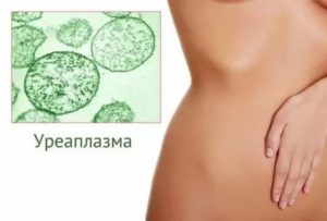 Уреаплазма только у мужа