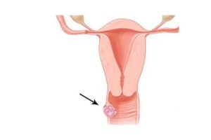 Киста влагалища