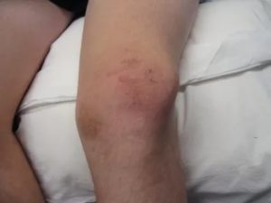Ушиб колена -гематомы по всей ноге распространяются