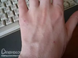 Лопнула вена на пальце руки, образовался синяк