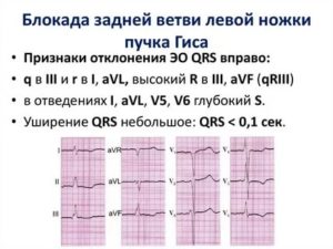 Блокада передней ветви левой ножки п. Гиса у ребенка