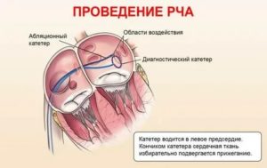 Экстрасистолия после РЧА сердца