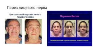 Порез нерва