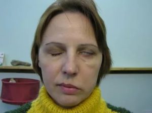 Порез нерва