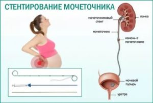 Выбор стента для мочеточника