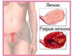 Пулъсация в области яичников