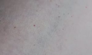 Мелкие красные точки на коже