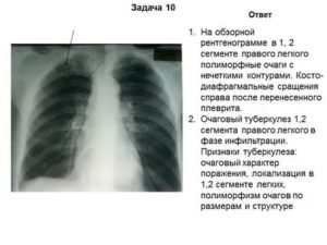 Флюорография петрификаты