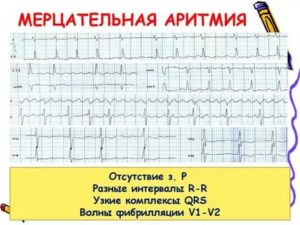 Мерцательная аритмия