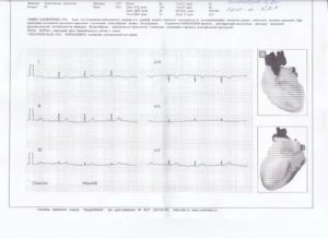 Расшифровка заключения кардиолога