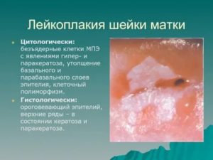 Кератоз шейки матки