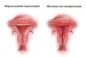 Кровотечение и гиперплазия эндометрии