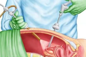 Лапароскопия или ГСГ после внематочной беременности