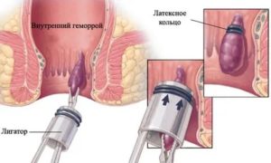 Ранка на геморроидальном узле