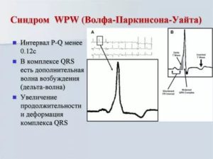 WPW синдром