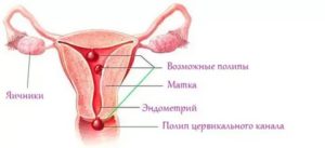 Полип в цервикальном канале