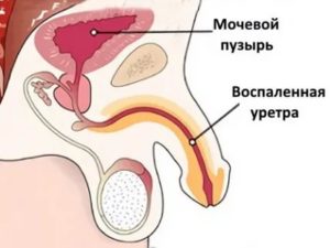 Жжение при мочеиспускании, слипание губ уретры по утрам