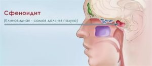 Хронический сфеноидит