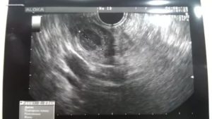 Кровотечение после узи