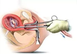 Половая жизнь после гистероскопии