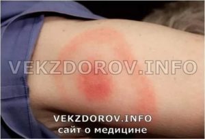 Увеличение лимфоузлов после укуса клеща