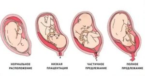 Краевое прикрепление плаценты