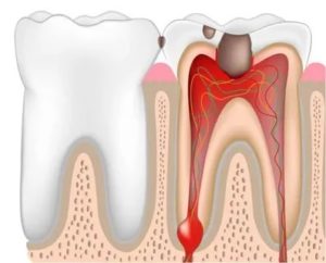 Боль в зубе при попадании холодного воздуха