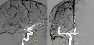 Расшифровка МРТ и МРА, артерии головного мозга