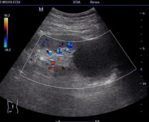 Затемнение в почке