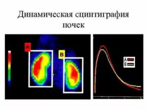 Неравномерное распределение РФП при проведении динамической сцинтиграфии почек