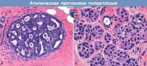Пролиферация апокриновых клеток