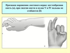 Боль в кисте при сжатии кулака или взятии предмета