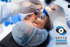 Осложнения после лазерной коррекции зрения методом LASIK