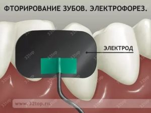 Электрофорез зубов