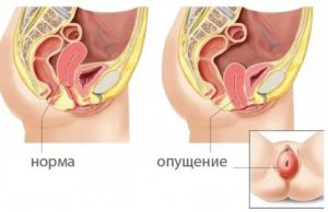 Лишилась девственности, боль при сексе, давит на мочевой пузырь