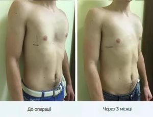 Деформация мечевидного отростка (возможно ли удалить)