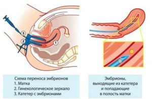 Подсадка эмбрионов во время кашля