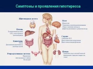 Может ли это быть гипотериоз