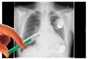 Можно ли делать рентген ладони, если установлен кардиостимулятор?