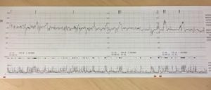 Помогите расшифровать КТГ на 36 неделе