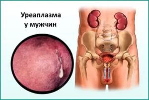 Порвался презерватив на фоне лечения от уреаплазмы парвум