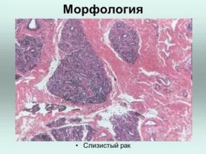 Муцинозная карцинома молочной железы