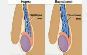 Беспокоит темно-фиолетовая вена на левом яичке