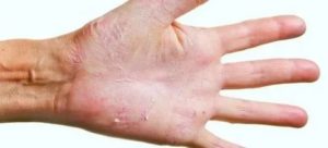 Чем лечить дерматит на кисти руки. Обнаружены споры грибка