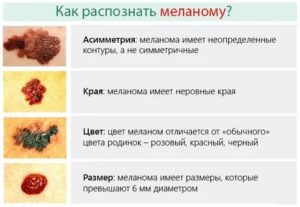 Может ли меланома быть доброкачественной